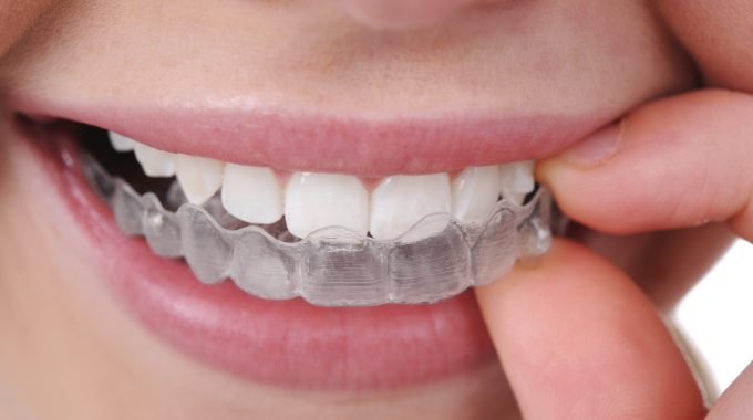 Invisalign3