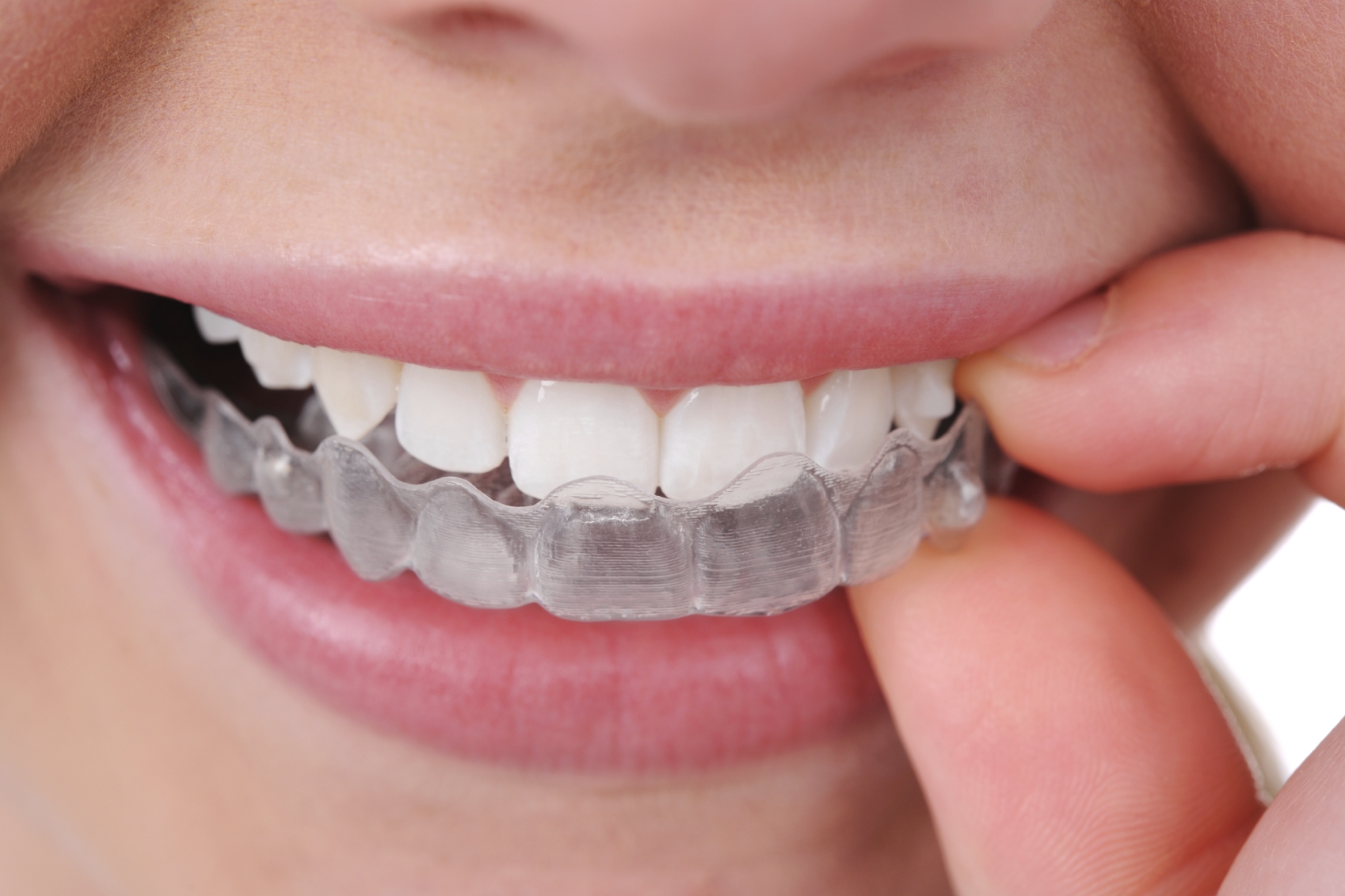 Invisalign3