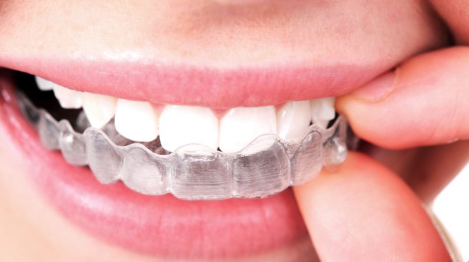 Invisalign