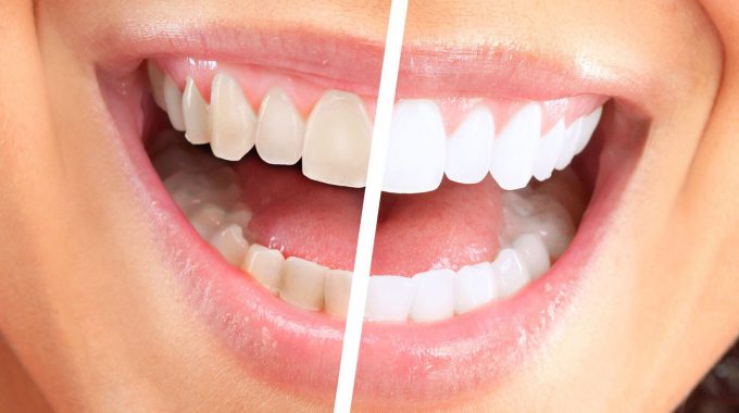 Sbiancamento Dentale Laser Bergamo